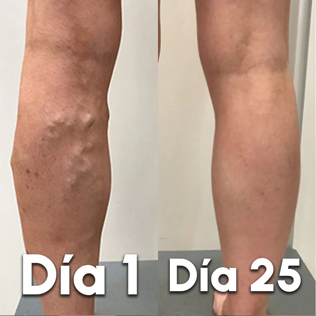 VariceFree Pro Kit Premium Spray + Parches