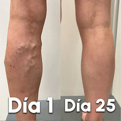 VariceFree Pro Kit Premium Spray + Parches