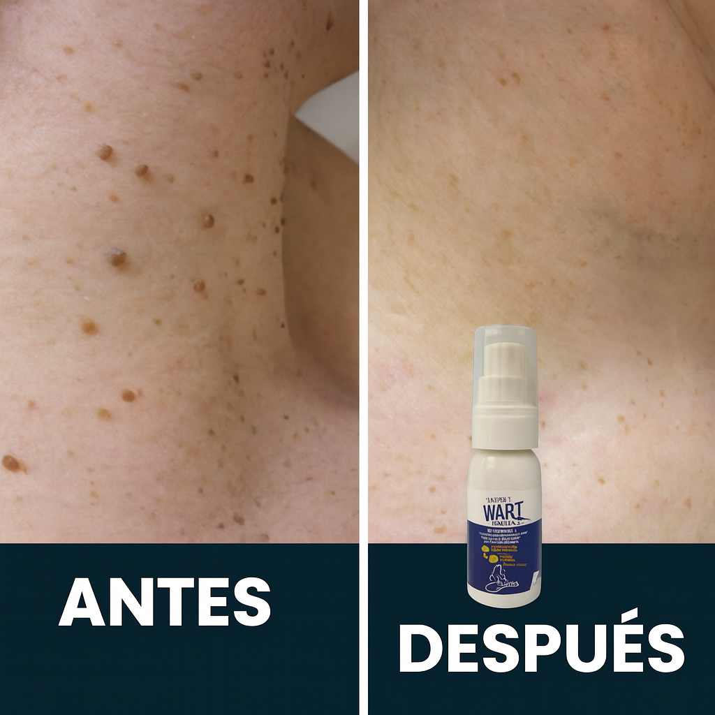 WART REMOVER ( removedor verrugas premium )