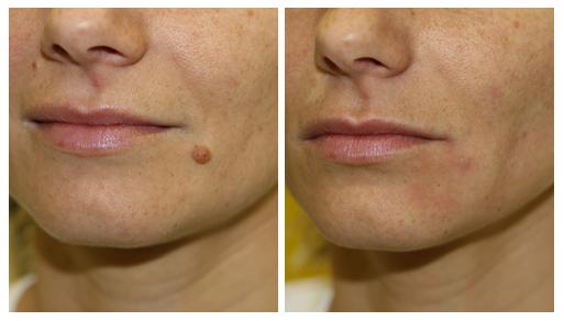 Parches Verrugas Premium ( Formula potenciada )